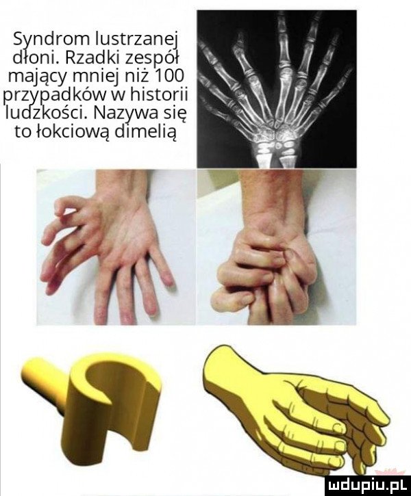 s ndromlustrzanej d oni. rzadki zespół mający mniej niż     pra ęadków w historii iu z ości. nazywa się to iokciową dimelią ai