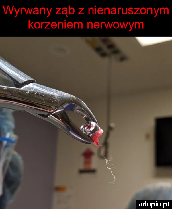 wyrwany ząb z nienaruszonym korzeniem nerwowym h w w